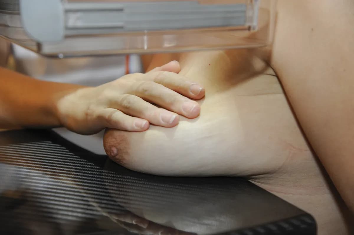 AI förbättrar bröstcancerdetektion i kliniska prövningar, minskar